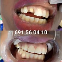 Prothèse dentaire - Cas 5